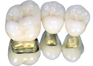 Протезирование зубов металлокерамикой в Советской Гавани - справедливые цены, гарантия 5 лет! Узнайте какие протезы лучше и их стоимость в клинике «Медиа-Стом»
