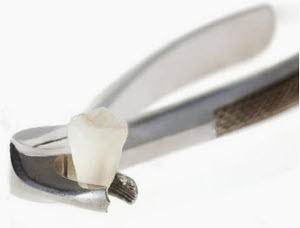 Удаление зубов в Cоветской Гавани